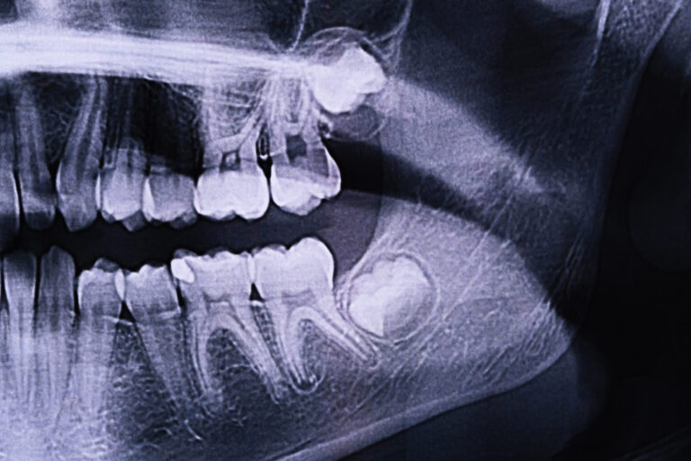 wisdom teeth ferntree gully dentist wisdom teeth ferntree gully dentist